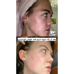 سرم ضد جوش اوردینری اصل حاوی نیاسینامید و زینک