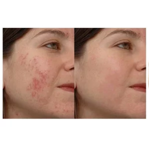 سرم ضد جوش اوردینری اصل حاوی نیاسینامید و زینک