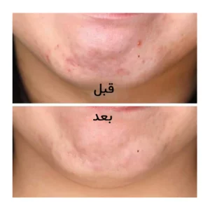 سرم ضد جوش اوردینری اصل حاوی نیاسینامید و زینک