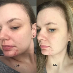 سرم ضد جوش اوردینری اصل حاوی نیاسینامید و زینک