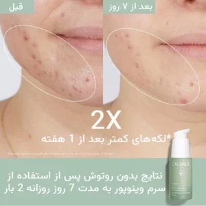 سرم سالسیلیک اسید کدلی ضد لک، ضدجوش، ضد آکنه