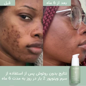 سرم سالسیلیک اسید کدلی ضد لک، ضدجوش، ضد آکنه