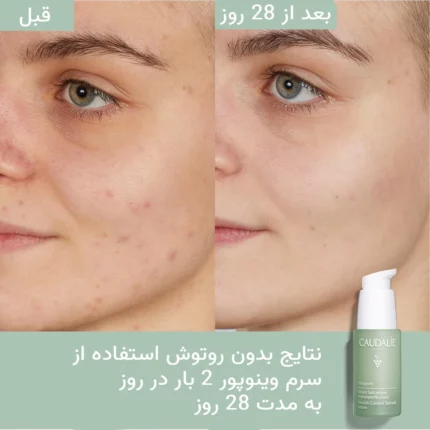 سرم سالسیلیک اسید کدلی ضد لک، ضدجوش، ضد آکنه